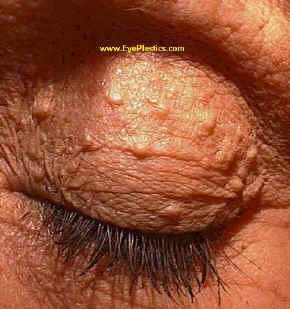 Epidermal Cysts