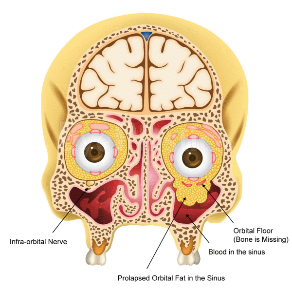 Orbital Fracture