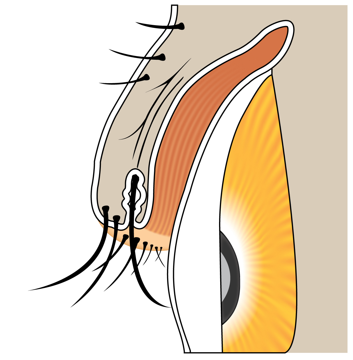 Trichiasis - Lashes pointing to the eye